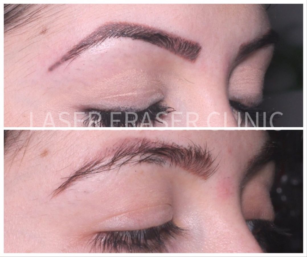 Vino pentru o îndepărtare tatuaj la Laser Eraser LaserEraser.ro